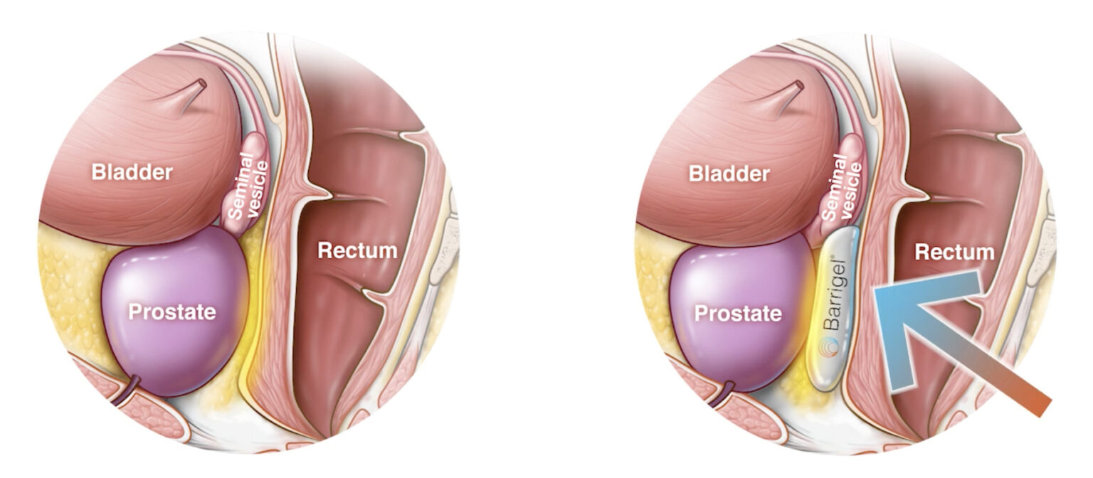 Barrigel Rectal Spacer - for Prostate Cancer Treatment