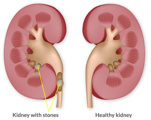 kidney-stone-illustration